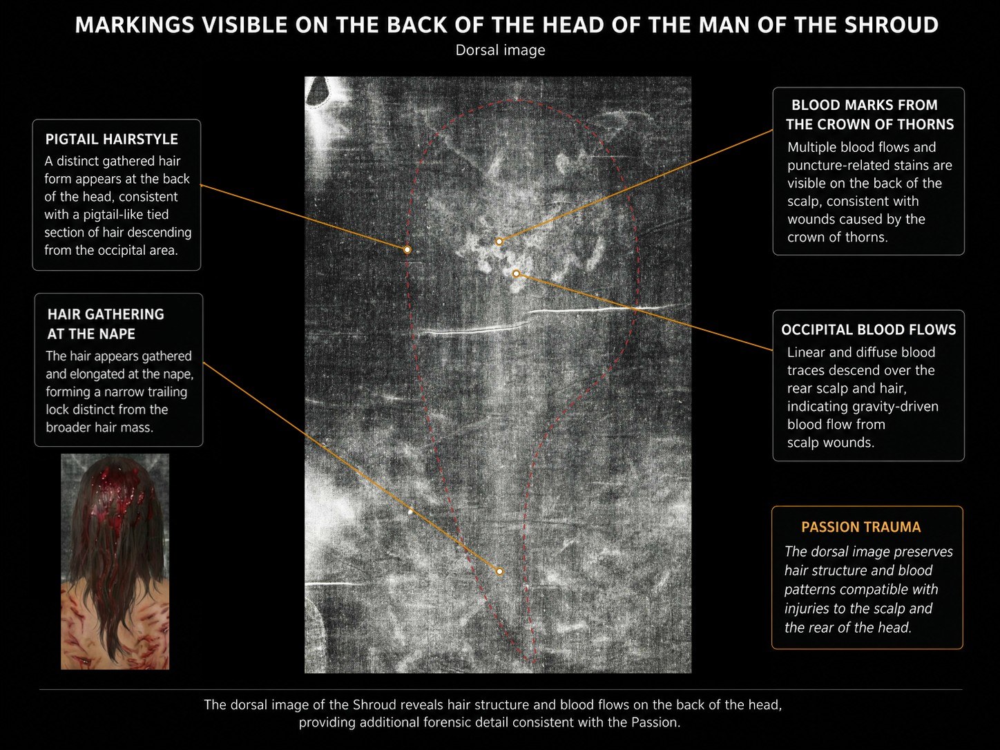 Photograph of the dorsal image of the head on the Shroud, showing the wound pattern on the scalp and the back of the head.